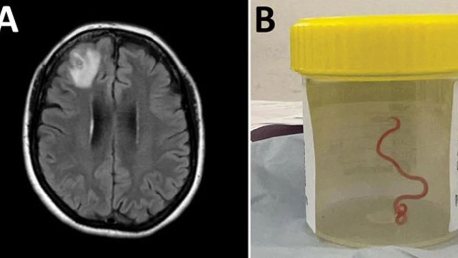 gusano cerebral