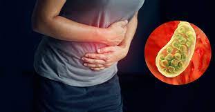 Cálculos biliares: causas, prevención y tratamiento